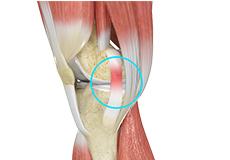 MCL Sprains