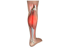 Medial Gastrocnemius Strain