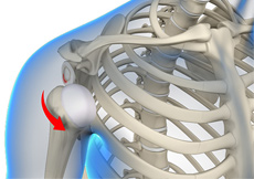 Multidirectional Instability of the Shoulder