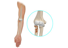 ORIF of Distal Radius Fracture