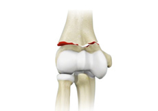 ORIF of the Distal Humerus Fractures