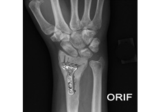 ORIF of the Forearm Fractures