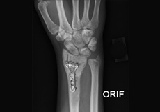 ORIF of the Humerus Fractures