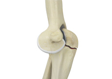 ORIF of the Olecranon Fractures