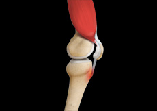 Osgood-Schlatter Disease