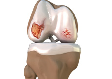 Osteoarthritis Management