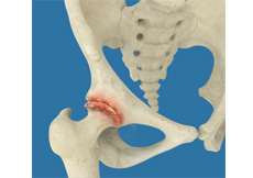 Osteoarthritis of the Hip