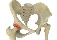 Osteoarthritis