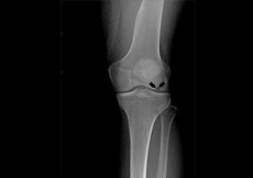 Osteonecrosis of the Knee