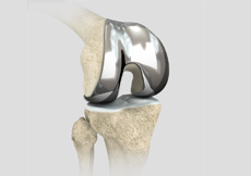 Outpatient Total Knee Replacement