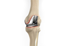 Painful or Failed Total Knee Replacement