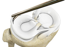 Partial Arthroscopic Meniscectomy