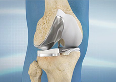 Partial Medial Knee Replacement