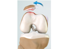 Patellar Dislocation