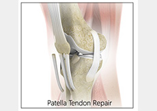 Patellar Tendon Repair