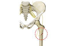 Pediatric Femur Fracture