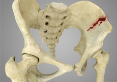 Pelvic Fractures