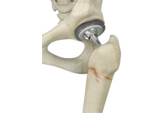 Periprosthetic Hip Fractures