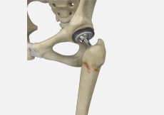 Periprosthetic Knee Fracture Fixation