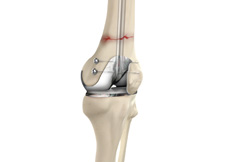 Periprosthetic Knee Fractures