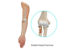 Radial Head Fractures of the Elbow