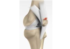 Recurrent Patella Dislocation