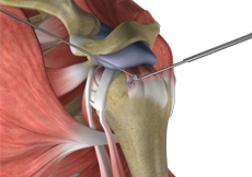 Rotator Cuff Pain