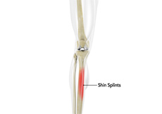 Shin Splints