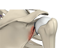 Shoulder Fracture