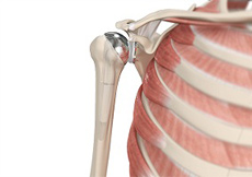 Shoulder Joint Replacement