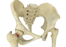 Stress Fractures of the Hip