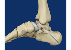 Subtalar Arthrodesis