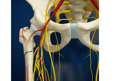 Subtrochanteric Hip Fracture