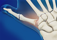 Surgery for Thumb and Digit Arthritis