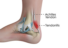 Tendinitis