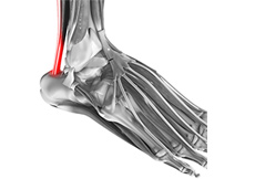 Tendinopathies