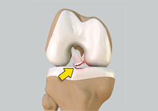 Tibial Eminence Fracture