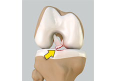 Tibial Eminence Spine Avulsion Fracture