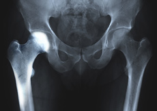Transient Osteoporosis of the Hip
