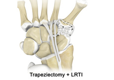 Trapeziectomy