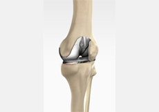 Tricompartmental Knee Replacement