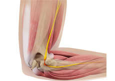 Ulnar Nerve Transposition