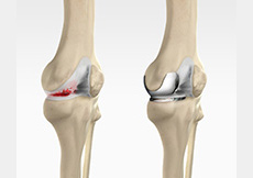 Unicompartmental/Partial Knee Replacement