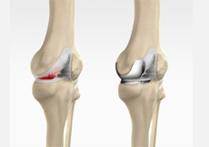 Unicondylar knee Replacement