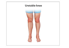 Unstable Knee