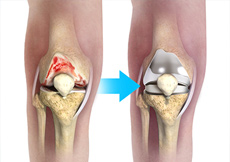 What is New in Knee Replacement