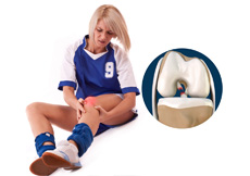 Women and ACL Injuries