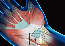 Wrist Ligament Tear and Instability